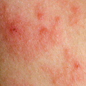 eczema atopic dermatitis symptom skin